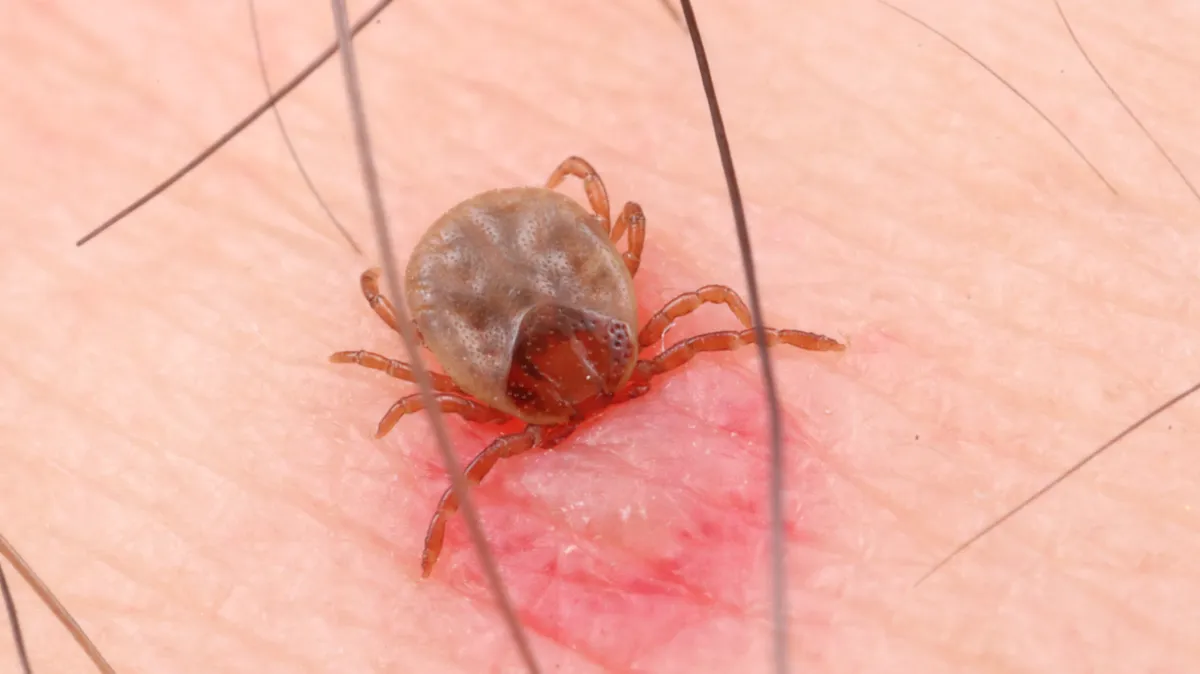 kullancs által terjesztett betegség tünetei, bőrpír