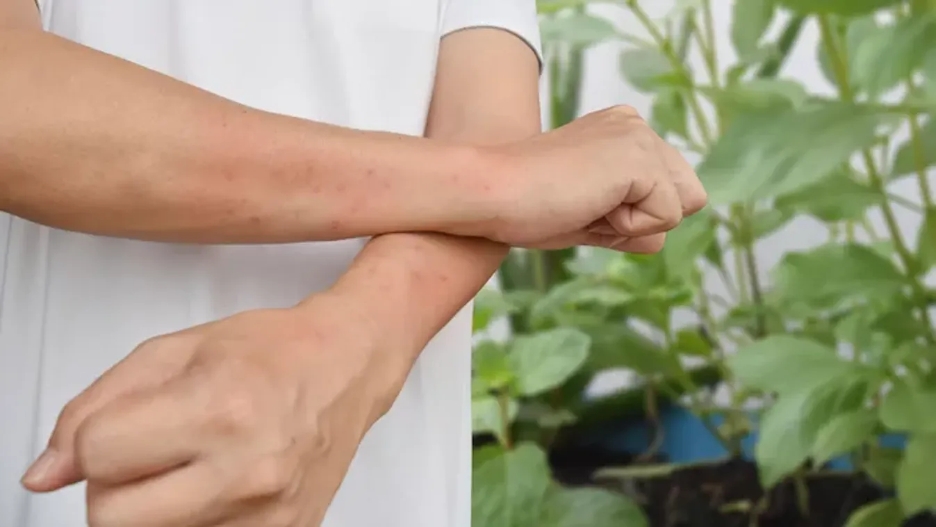 Megcsípett a csalán? Így kezelheted házi módszerekkel