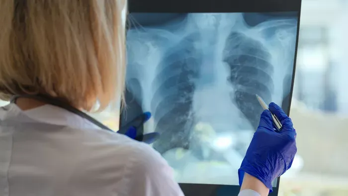 Ha ilyen tüneteid vannak, valószínűleg TBC-d van