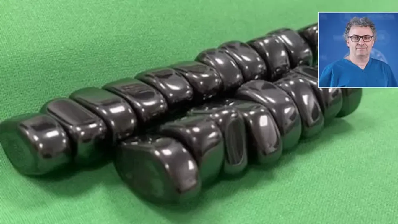 Egy hétig a gyermek gyomrában lehettek a mágnesek – megszólal a műtétet felügyelő orvos