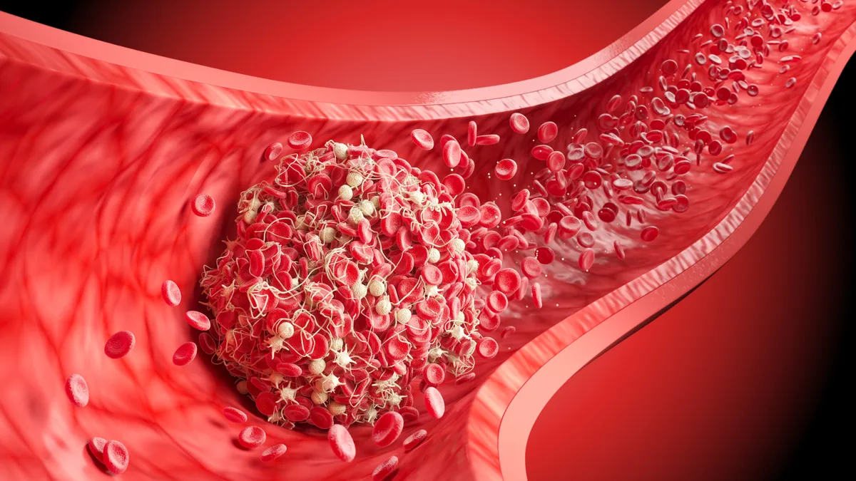 Vérrög okozta érelzáródás a szívben.