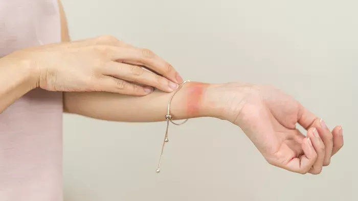 Kontaktallergia - Vajon mi váltja ki?