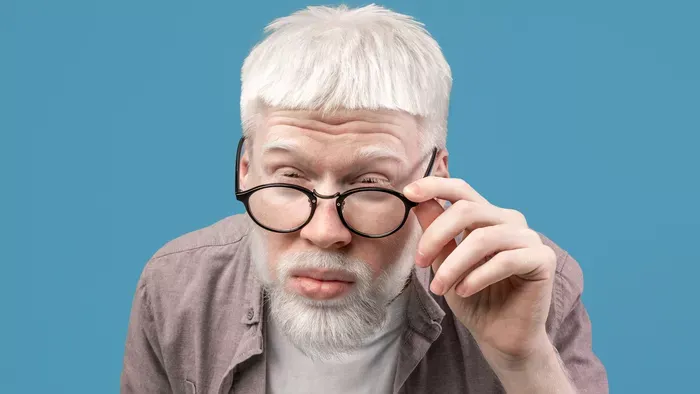 Albinizmus: amikor a szépség az egészség rovására megy