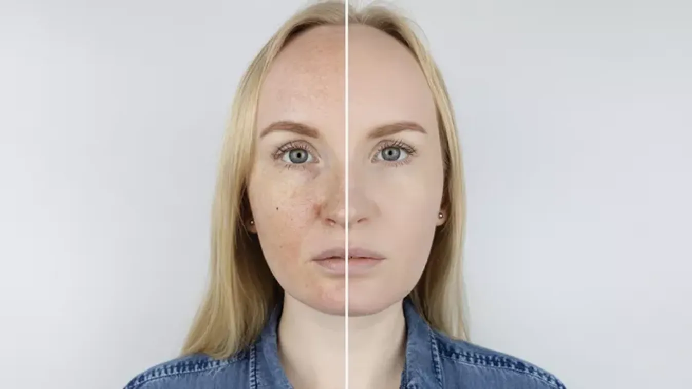 Ijesztő, mit művel a tavaszi nap a bőröddel – Így védekezz ellene