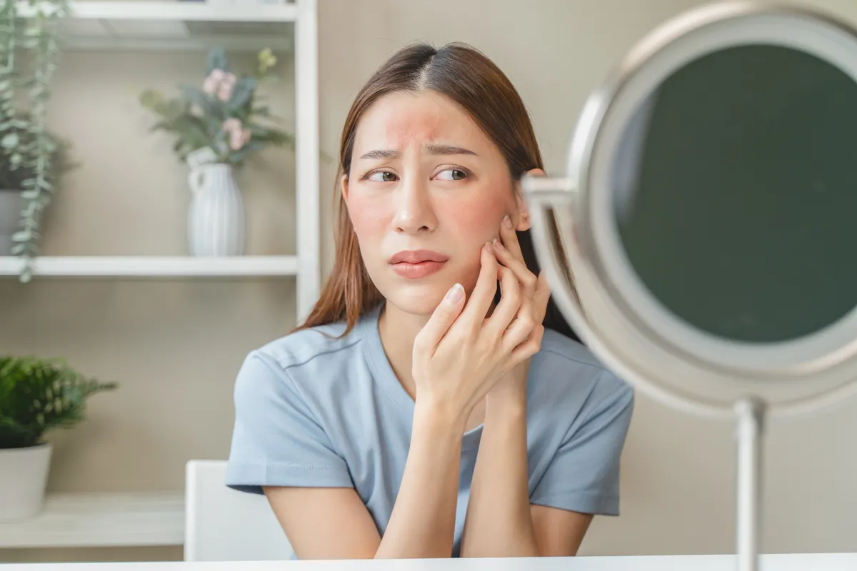 Kontaktallergia a lány arcán.