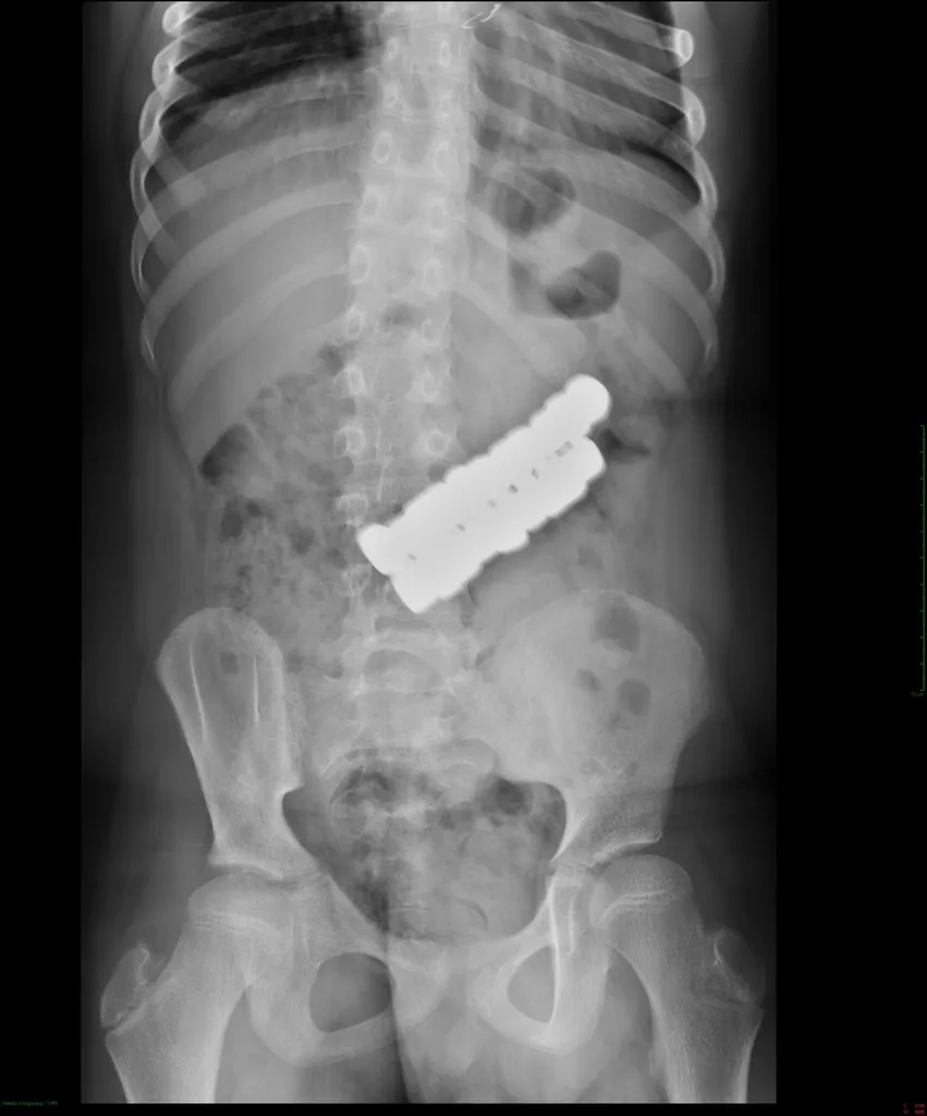 A lenyelt mágneseket csak műtéttel tudták eltávolítani a szakorvosok.