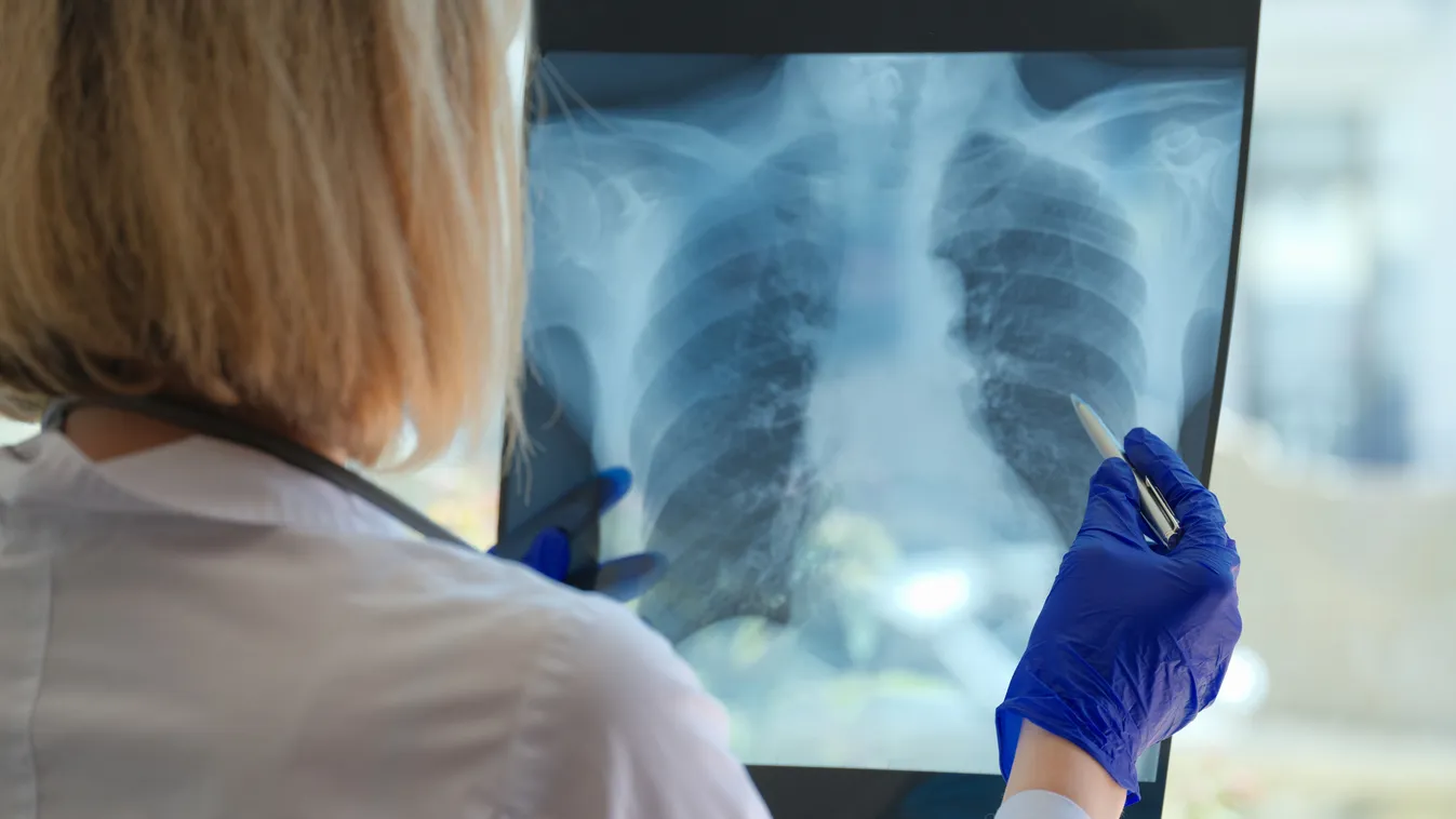 Ha ilyen tüneteid vannak, valószínűleg TBC-d van