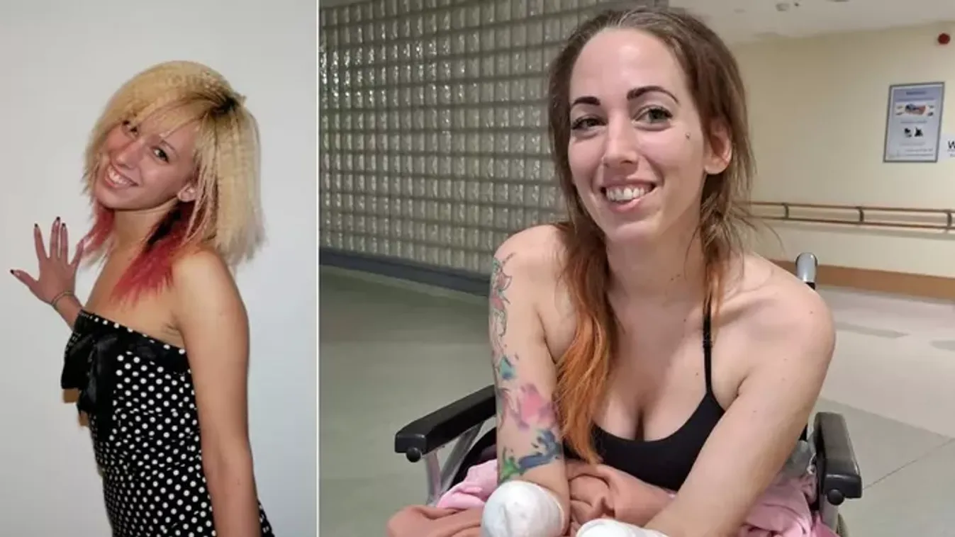 Elkezdődött a rehabilitáció: Fogat mos, villával eszik és már ollóval is vág a négy végtagját elvesztett Fanni