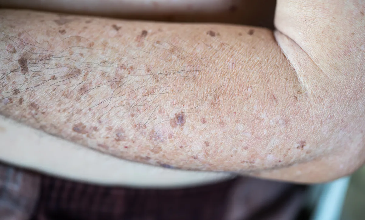 Időskori májfoltok egy idős férfi alkarján
