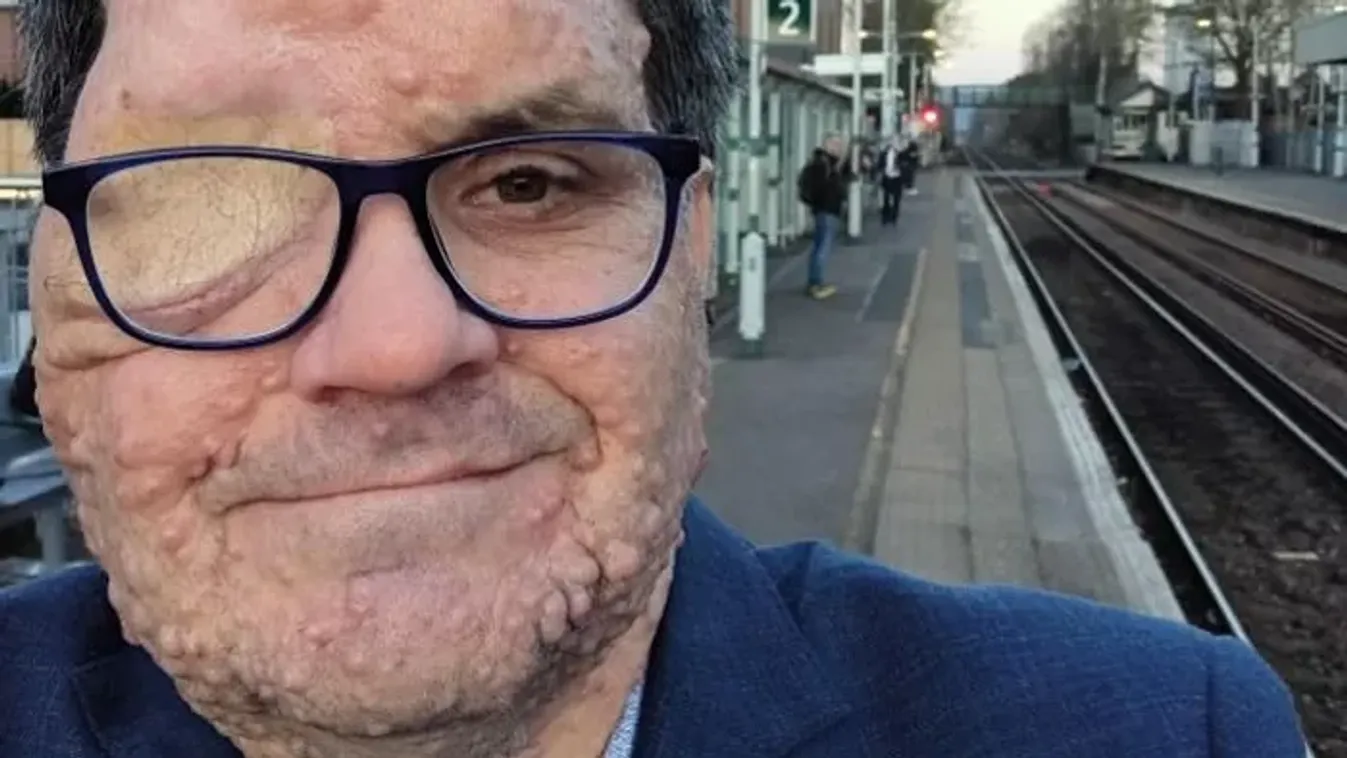 Küklopsznak hívták: "Sokat csúfoltak, miután egy ritka betegség miatt csak egy szemem maradt”