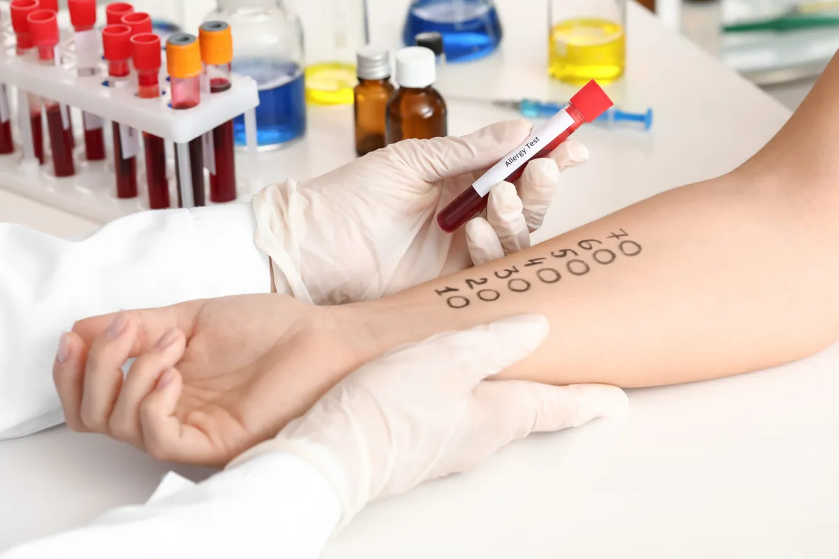 allergiavizsgálat bőrteszt