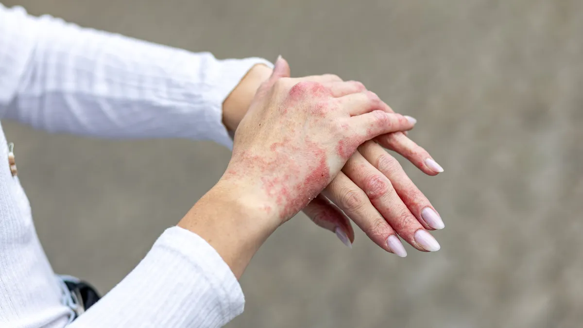 Így néz ki a pokol: az agresszív ekcéma és a gyógyszerfüggőség miatt Rosemary bőre cafatokban lógott