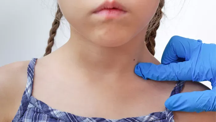 Veszélyes csomók, anyajegyek a gyereknél: vedd észre időben!