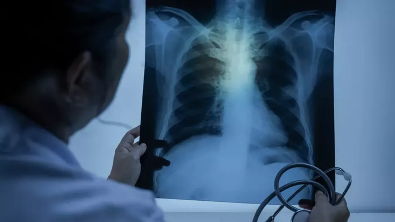 "Nem lehet tüdőrákom, hiszen soha nem dohányoztam!" Pár évet jósoltak az anyának, hat évvel később eltűnt a daganat