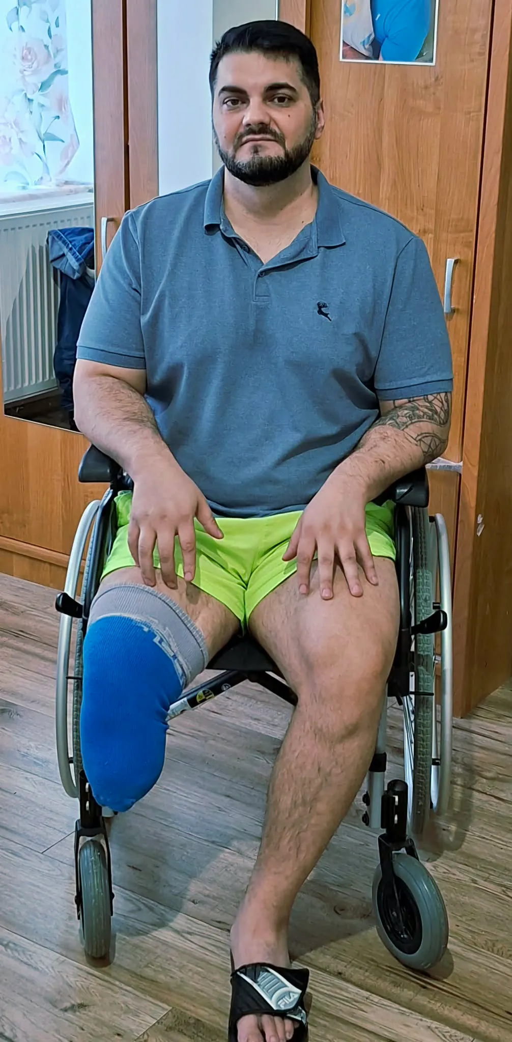Tamást lelkileg nagyon megviselte az amputáció