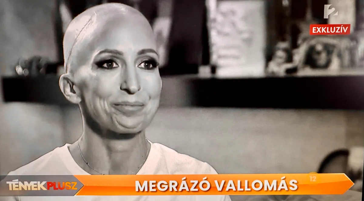 Rubint Réka rákos, daganatos betegséggel küzd, parókát hord