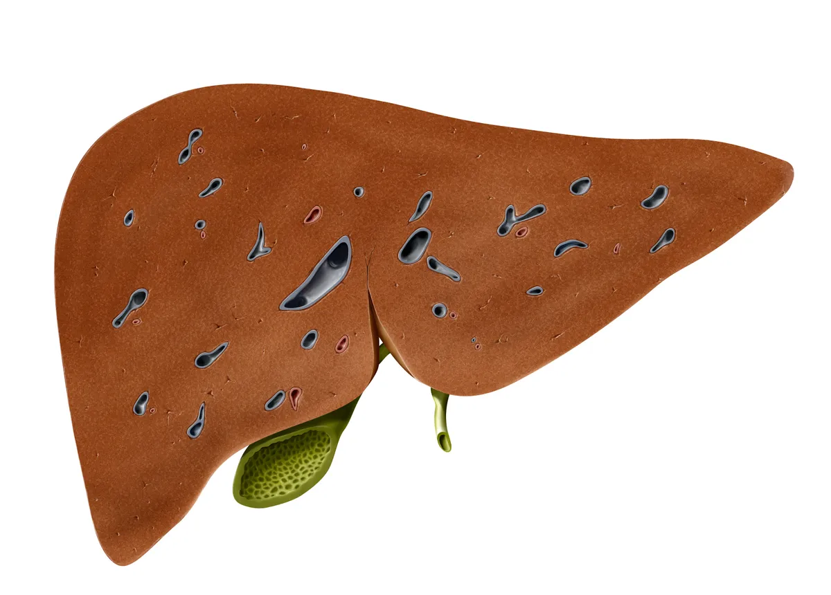 A zsírmáj következménye: májirózis.