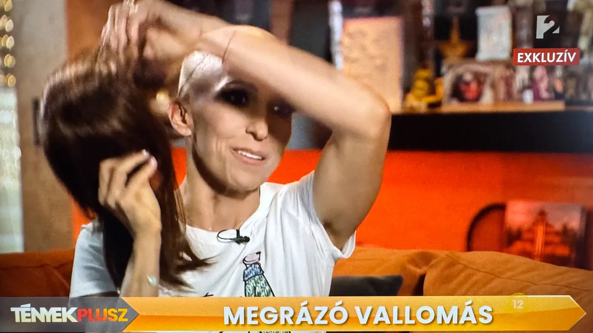 Rubint Réka rákos betegséggel küzd, parókát hord