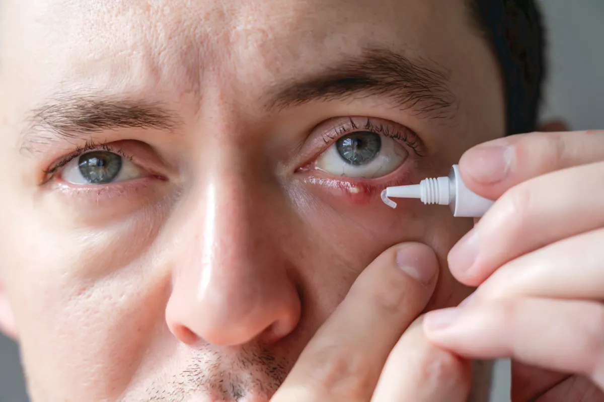 Szemárpás szemére kenőcsöt kenő férfi