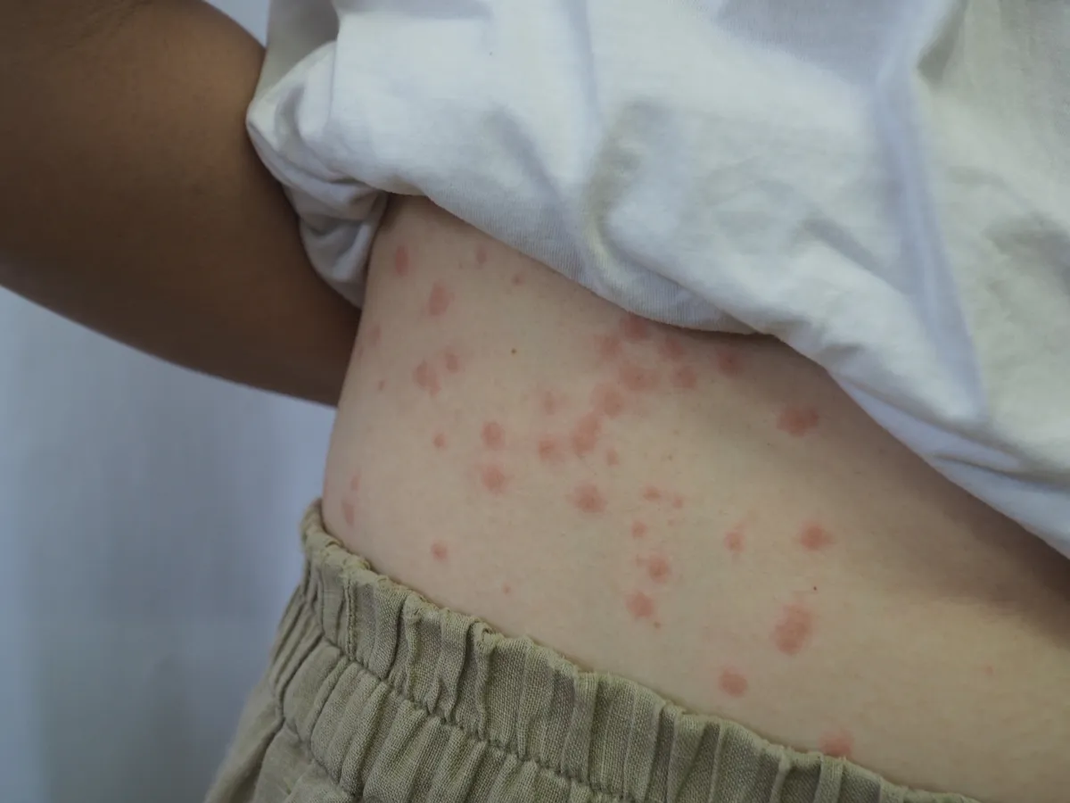 Hisztaminérzékenység miatt kiütések a törzsön