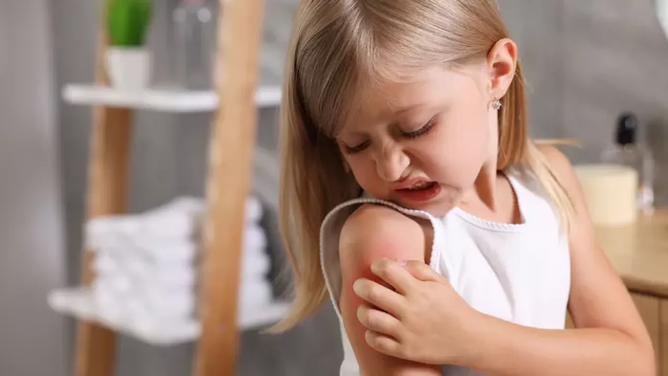 Ekcémás a gyereked? Sokkoló, de ez a szokás tovább súlyosbíthatja a tüneteket