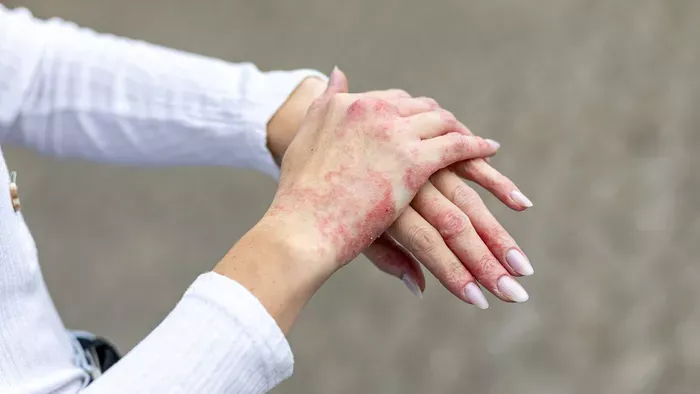 Rémálommá vált a költözés: lehámlott a bőre a fiatal nőnek