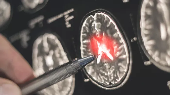 A remegésen túl: amit tudnod kell a Parkinson-kórról