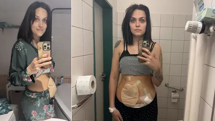 Csupán puffadással kezdődött, ma sztómával él Anita