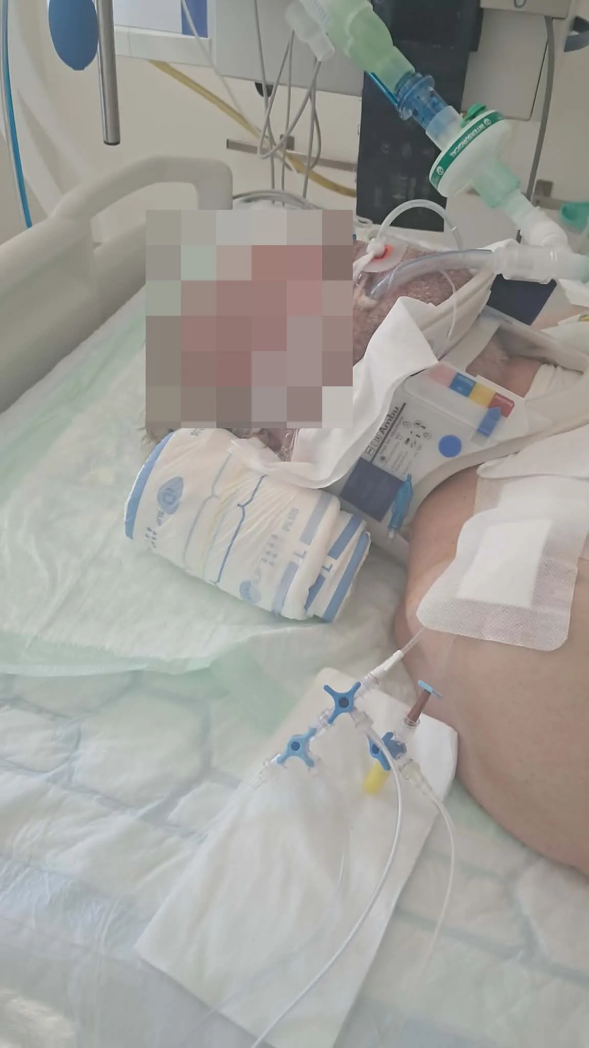 Imre az intenzív osztályon fekszik, mivel két csigolya eltört a nyakában