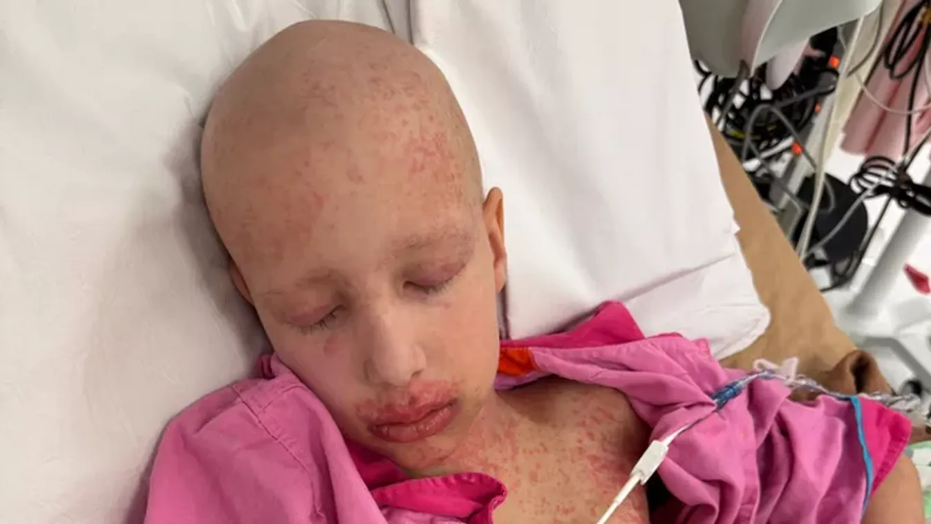 Bedugult orra miatt panaszkodott a 9 éves kislány – agresszív rákot diagnosztizáltak nála