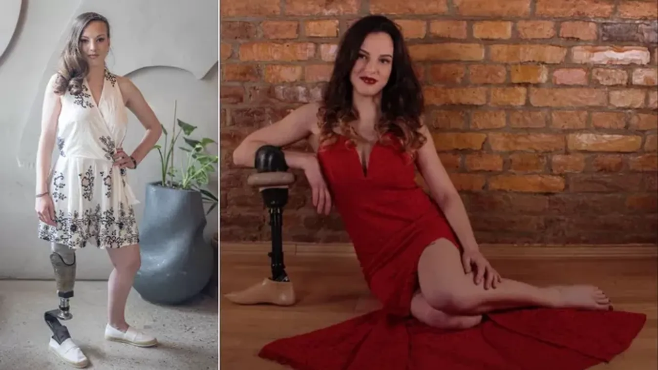 “17 évesen úgy döntöttem, hogy amputálják a lábamat” - Daniella számára megkönnyebbülés volt, hogy elvesztette jobb lábát