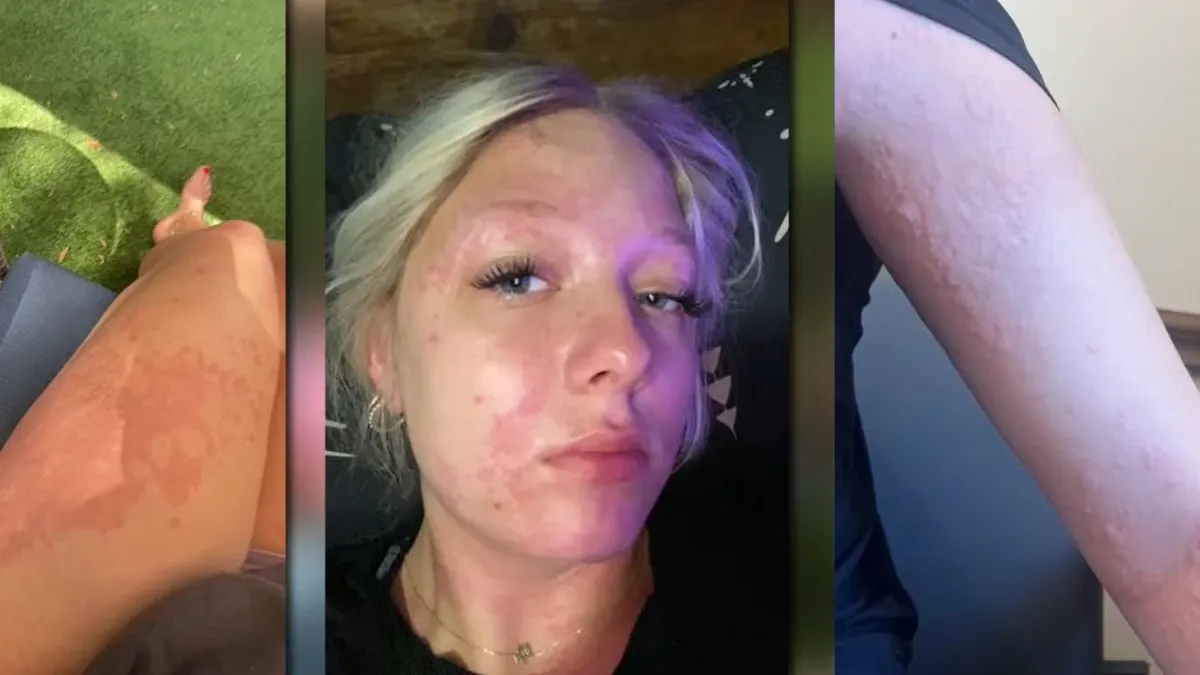 Tetőtől talpig megégett egy 16 éves lány teste zuhanyzás köz