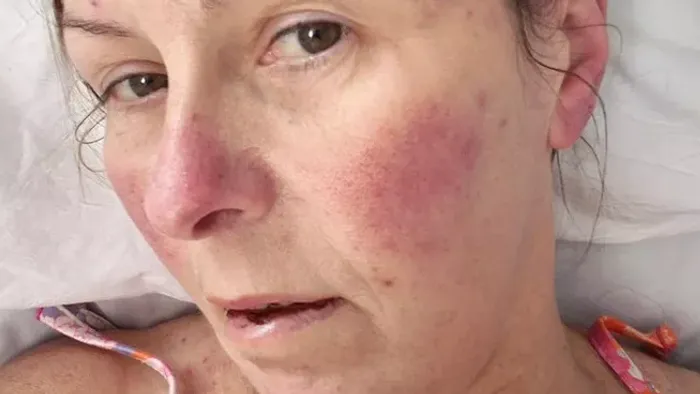Menopauzára fogta a tüneteket, leukémiája volt