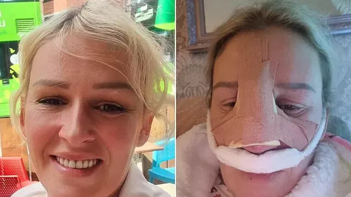 Azt hitte, eltörte az orrát – egy ritka rák tünetei voltak